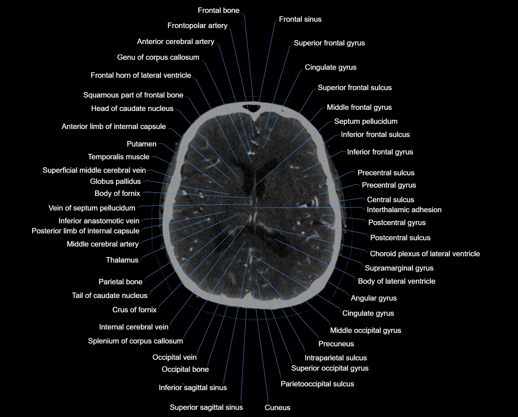 CT scan brain axial labelled cross sectional anatomy image-img-000039.webp